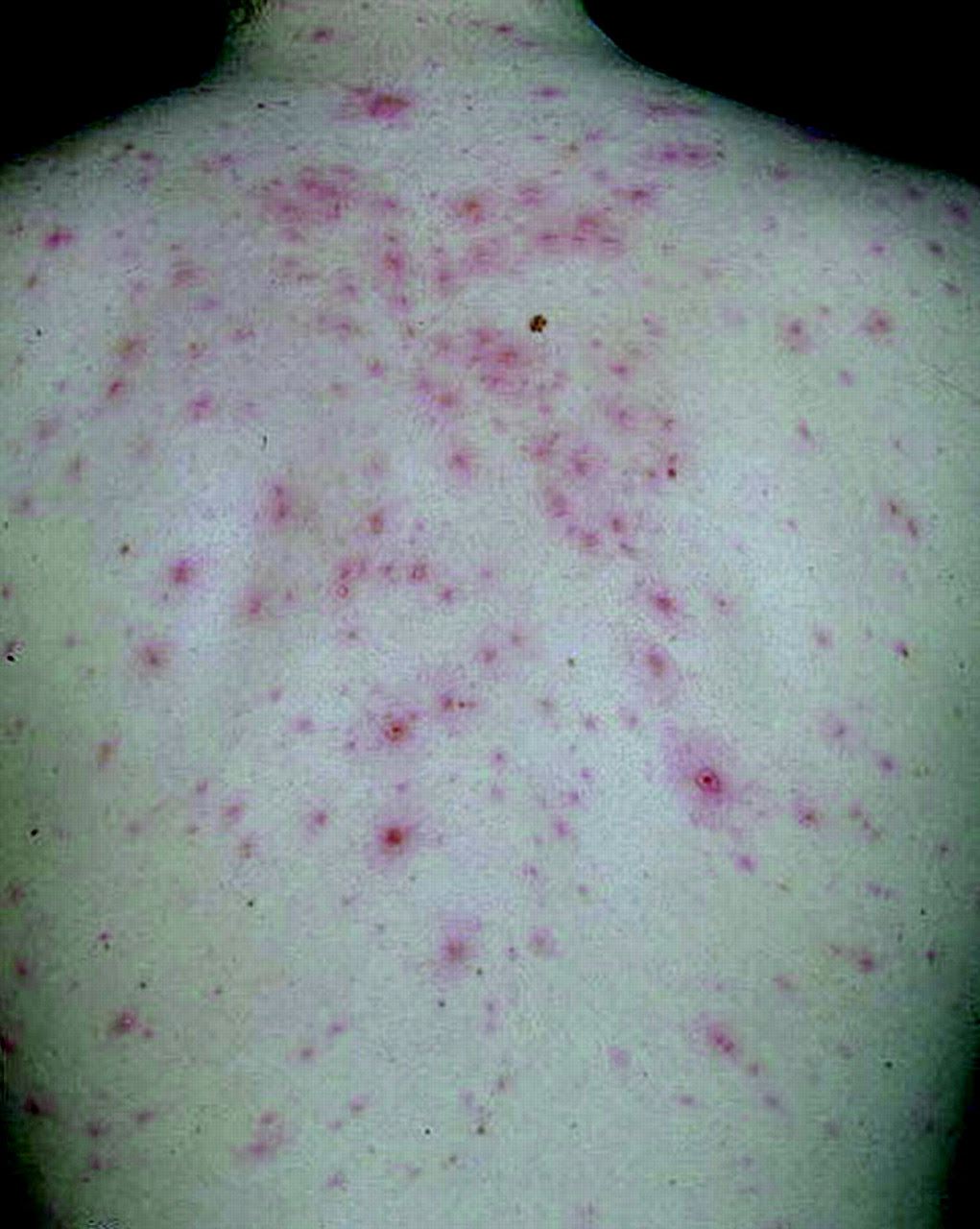 Rashes You Need to Know: Common Dermatologic Diagnoses