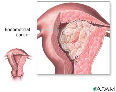 Uterus cancer