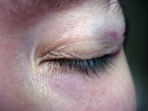 my eye feels sore