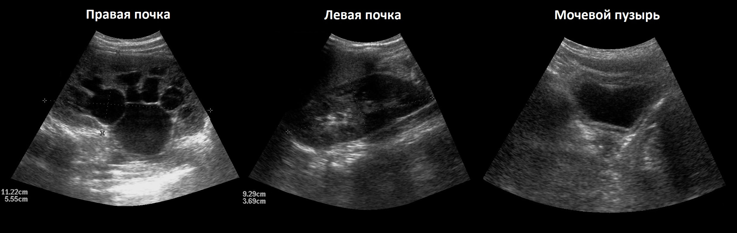 Двусторонний рефлюкс мочевого пузыря
