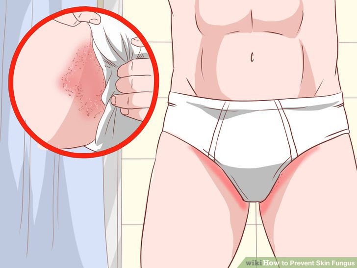 Prevent Skin Fungus Step 9 Version 2.jpg