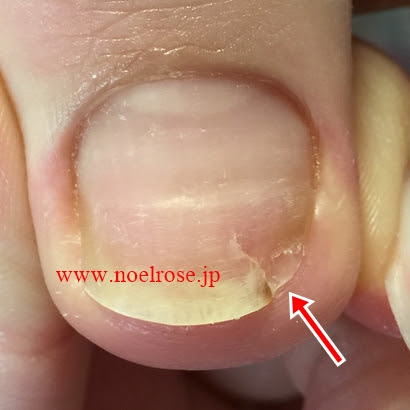 痛い お肉の所からバッキリ爪を折ってしまったら News 新宿 中落合 落合南長崎 のネイルサロン ノエルローズ