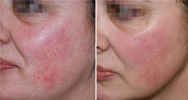 trattamento laser per couperose costi