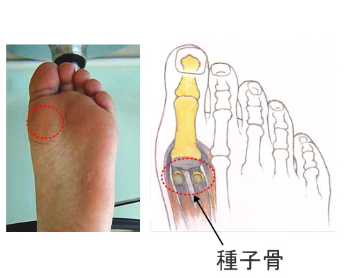 足の親指の裏の痛み 種子骨障害 よくある症状 疾患 札幌スポーツクリニック 札幌市中央区の整形外科 内科 リハビリ科