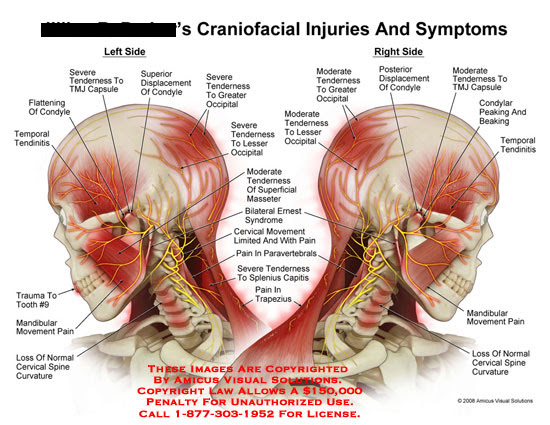 What Causes Left Side Head And Neck Pain Induced Info