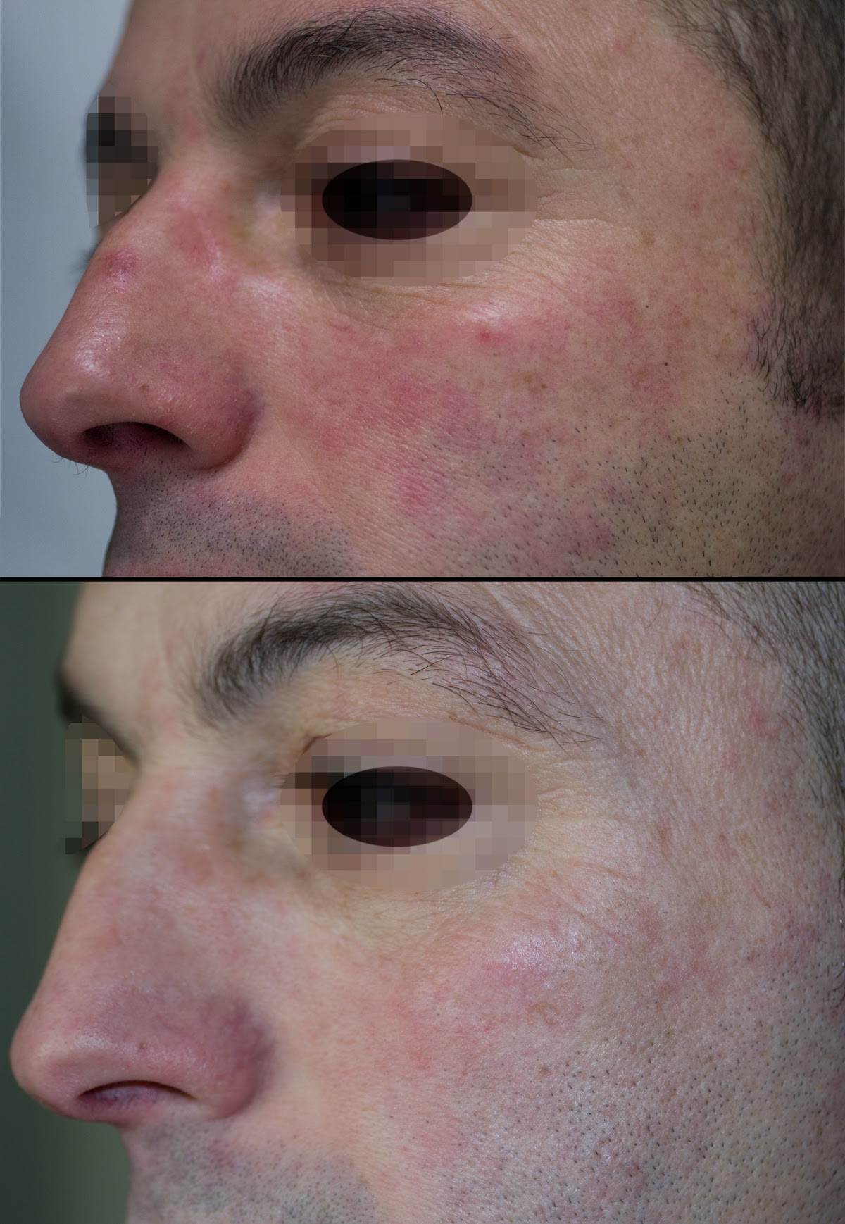 laser capillari viso