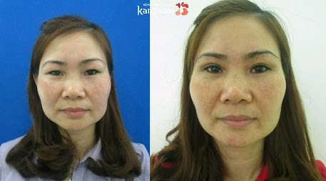 có nên cắt mí mắt không 3