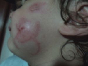 Família registrou os machucados feitos pelas mordidas.  (Foto: reprodução/arquivo pessoal )