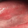 Basal Cell Carcinoma Cancer Lumps Under Skin : Interdigital cysts and their God-forsaken therapies - The strongest risk factor for developing skin cancer is ultraviolet (uv) ray exposure, typically from the sun.