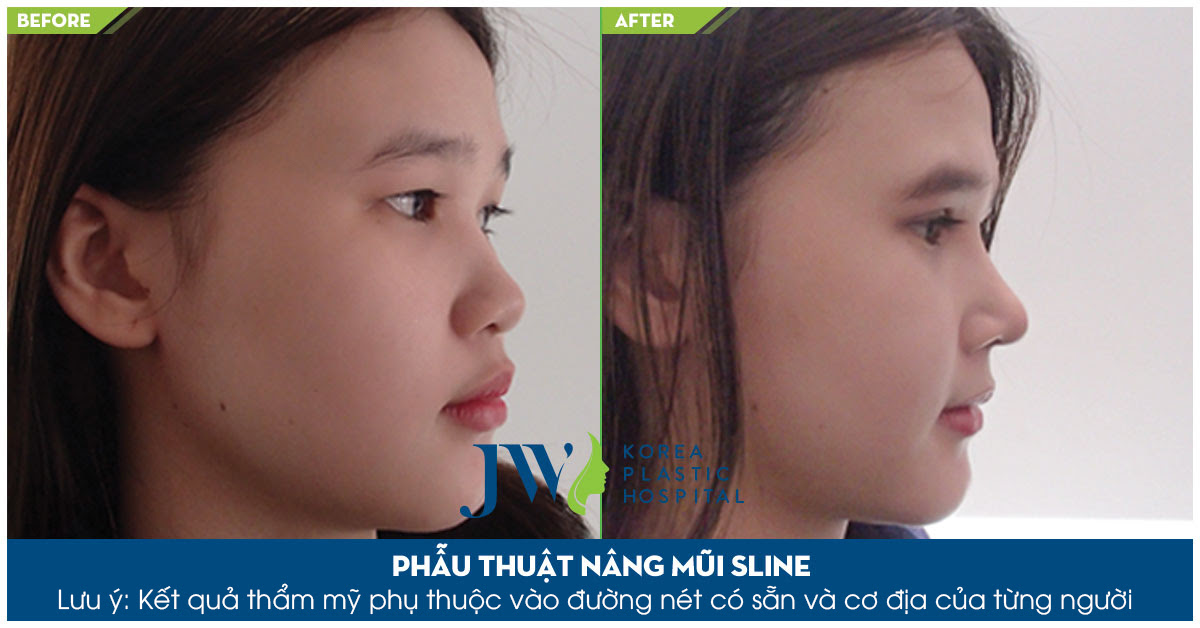 Nâng mũi S Line khắc phục khuyết điểm mũi tẹt, gồ, to, bè