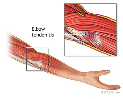 Elbow Tendonitis