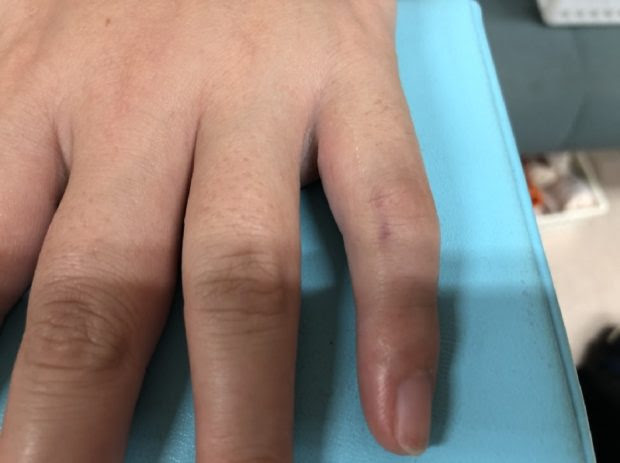 突き指 脱臼 むずかしい指の脱臼の整復 はずれた関節をはめる 長崎市のはしぐち整骨院 日曜営業 交通事故治療 足底筋膜炎