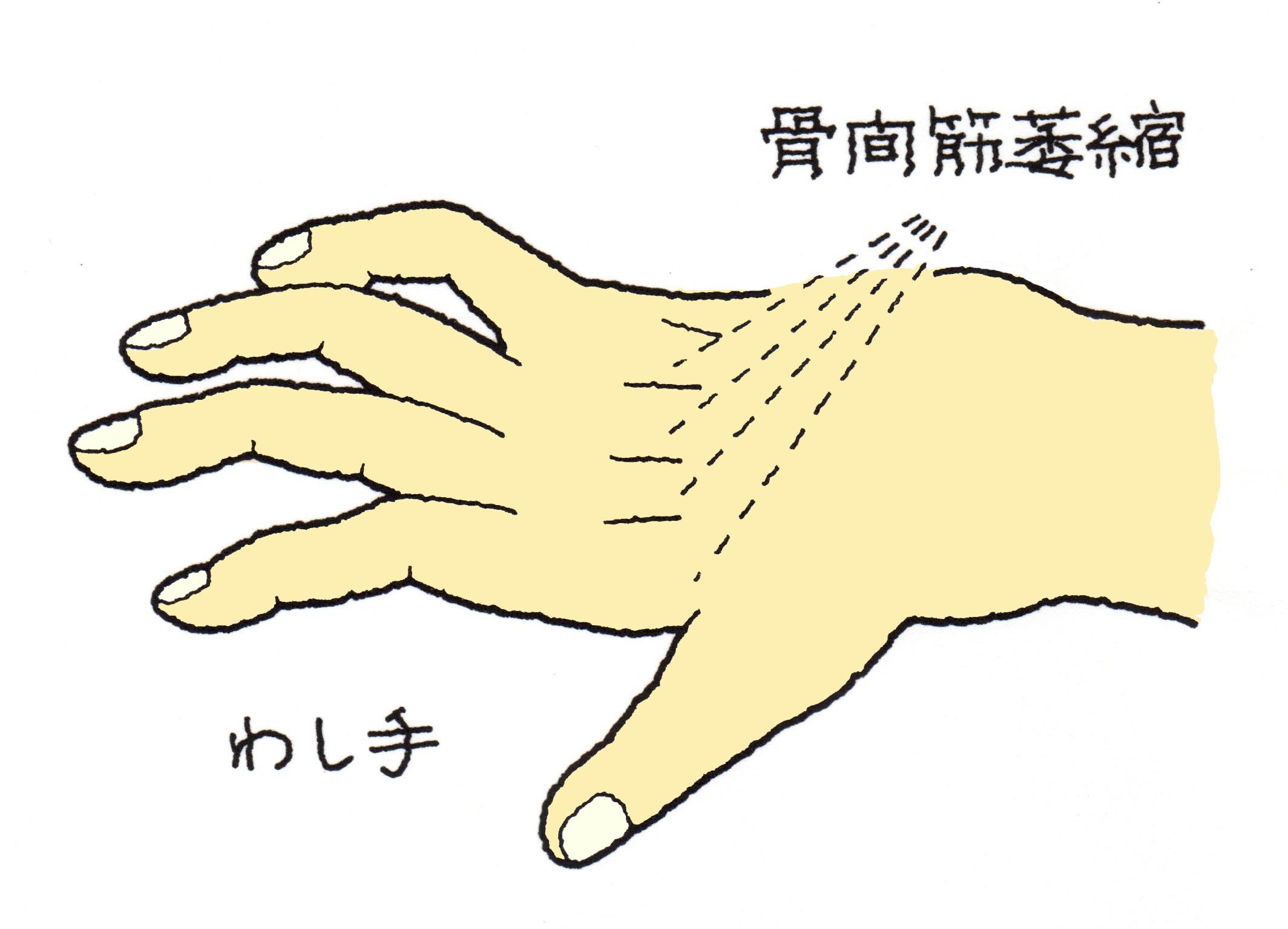 肘の内側々副靱帯損傷 ひじのないそくそくふくじんたいそんしょう 福岡の弁護士による後遺障害 等級認定サポート