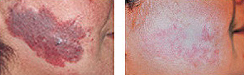 Skin Cancer Lesions On Arms