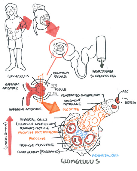 Nephritic Syndrome Armando Hasudungan