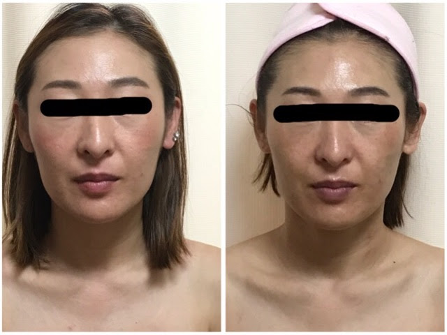 小顔顔痩せ輪郭が変わるスライドカッピングモニター Jpg