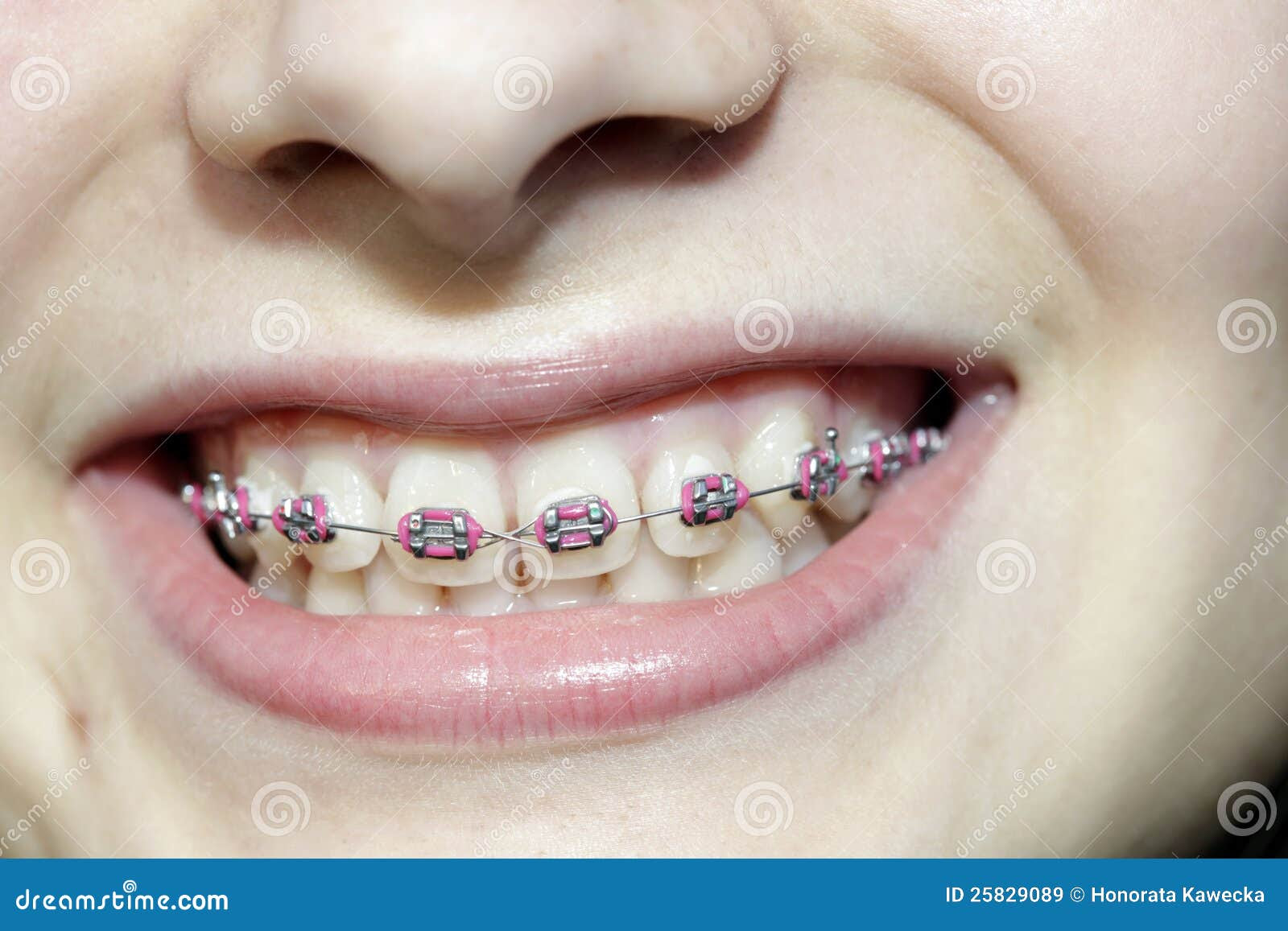 Remarkable Teeth with Braces 1300 x 957 · 102 kB · jpeg