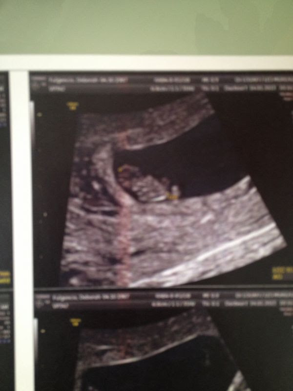 Compte Rendu Echographie De Datation 7sa 6 Nous Et Notre Surprise De Noa L Accouchement Prevu Le 3 Septembre 13