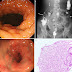 String Sign In Crohn's - String sign is a medical term used in diagnosing hypertrophic pyloric stenosis (hps).