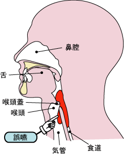 誤嚥性肺炎