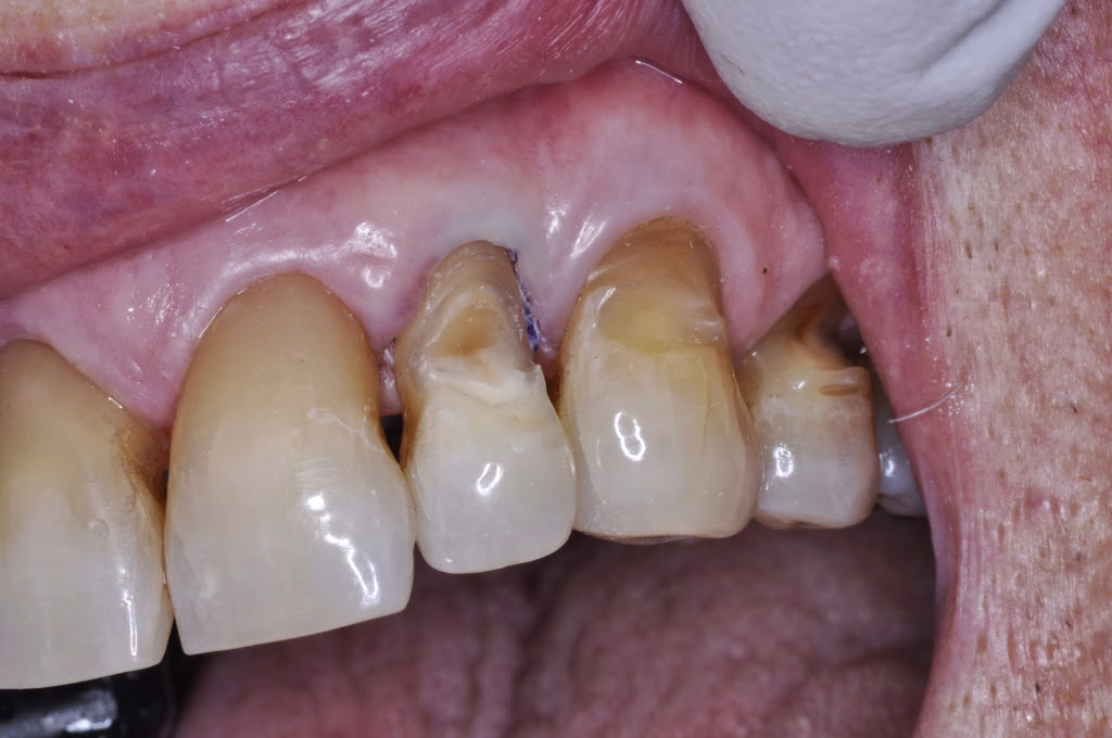 Dentist New York 10016- Dr Lawrence Spindel - Abfraction