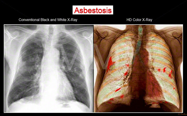 asbestosis white blood cells