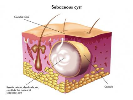 radiothérapie et chimiothérapie