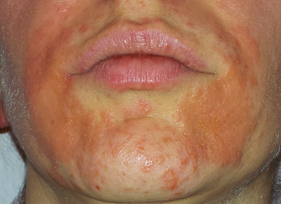 Ausschlag Im Gesicht