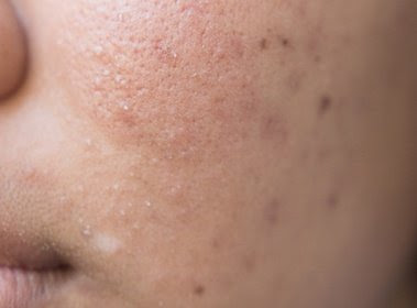 35 Cara Menghilangkan Bekas Jerawat (Secara Alami & Modern)