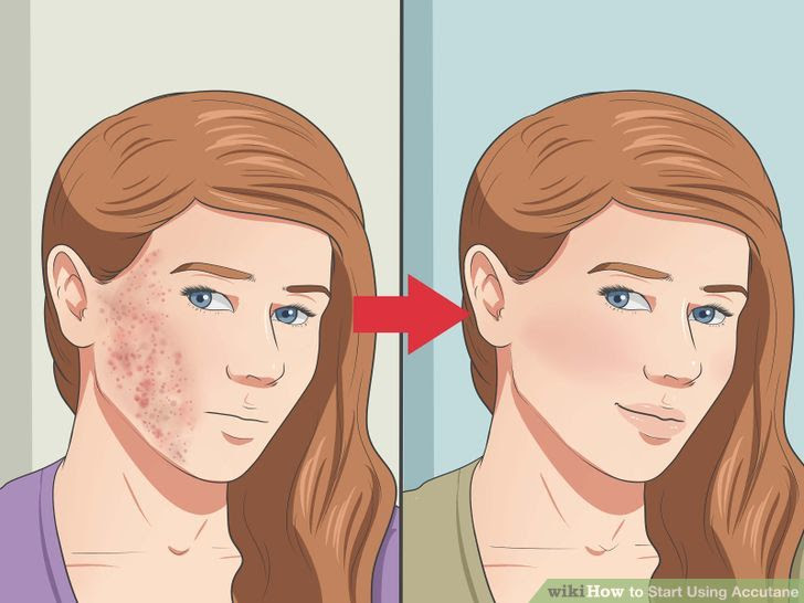 Start Using Accutane Step 21.jpg