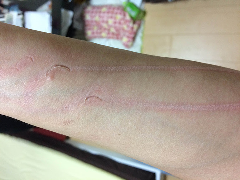 Dv 痣
