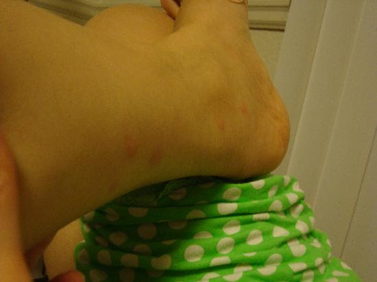 bites on feet - Picture of Maile Sky Court, Honolulu - TripAdvisor
