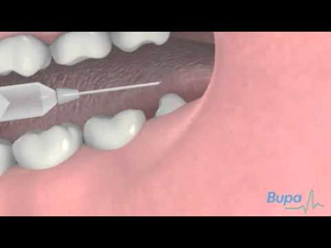 How a wisdom tooth is removed - YouTube