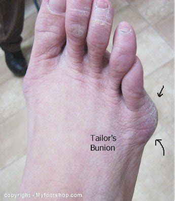 Plantar fasciitis can cause intens. Tailor's Bunions | Causes and treatment options