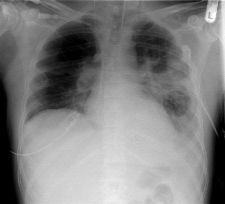 If untreated, Klebsiella pneumonia, dies ... streptococcus pneumoniae pathogenesis