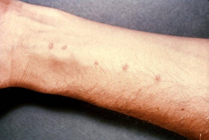 itching in anus. Swimmer#39;s itch - schistosome