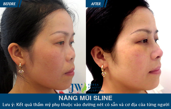 Sau khi nâng mũi S Line, chiếc mũi trở nên hài hòa với gương mặt