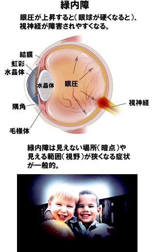 緑内障の最新情報 9割の人が緑内障に気付いていない 定期検診が必要 ニュース 一般社団法人 日本生活習慣病予防協会