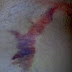 Show Me The Groin Area / What can you do for a hernia at home, IAMMRFOSTER.COM / Howe recommends powders, especially in the groin, to help soak up excess moisture and help prevent skin from rubbing too much.