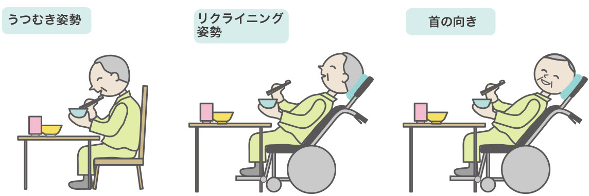 嚥下障害の説明です 嚥下造影検査や嚥下リハビリを実施