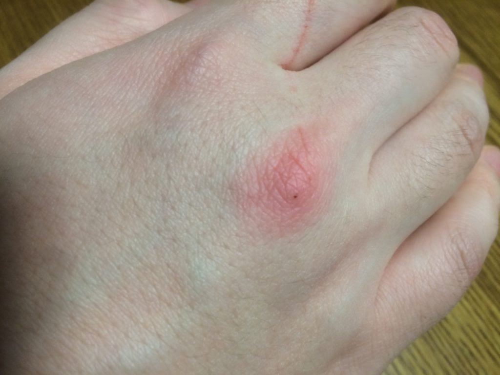 ネコの爪が手に刺さった そして腫れてきた 甘く見ていると大変なことに いろいろんブログ