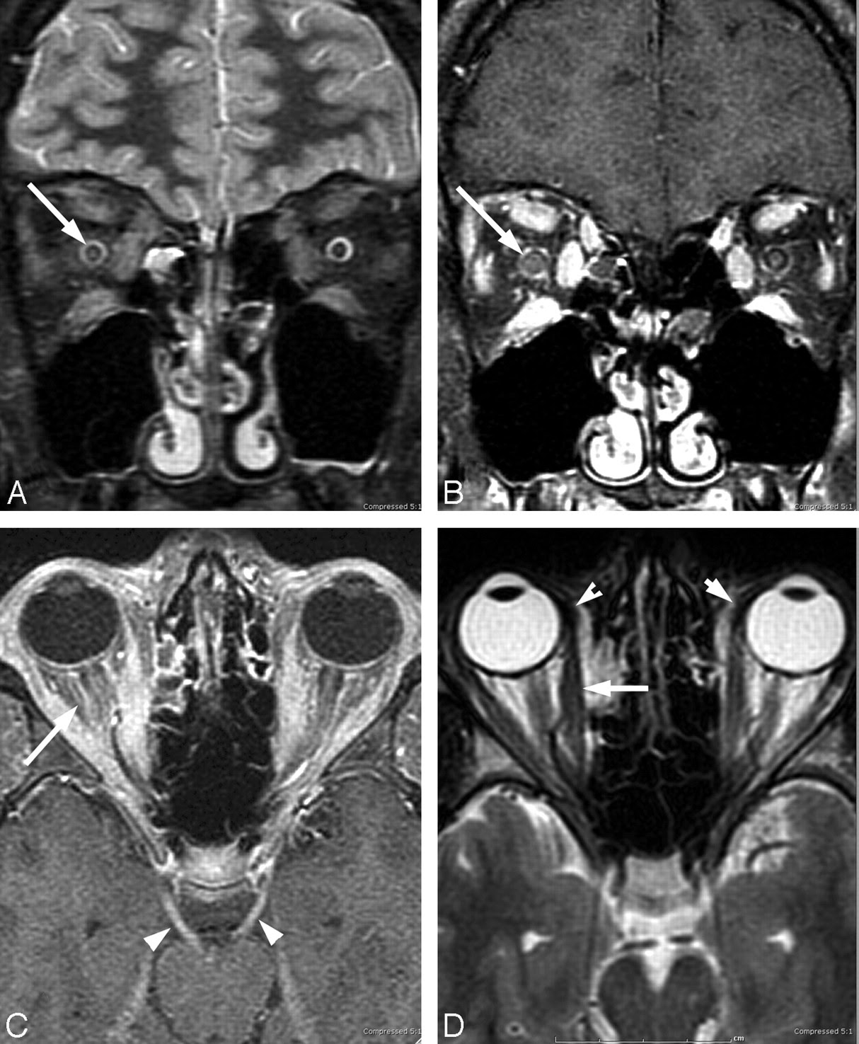 Lyme Neuroborreliosis Manifestations Of A Rapidly Emerging Zoonosis American Journal Of Neuroradiology