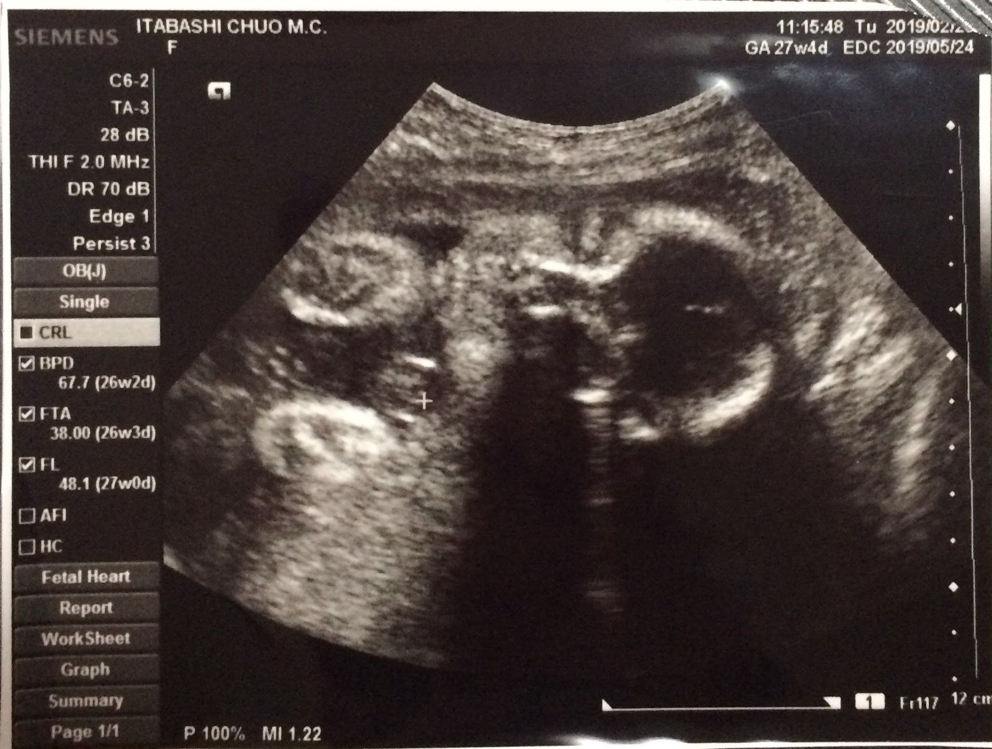妊娠27週 3 6日 のエコー写真 体験談