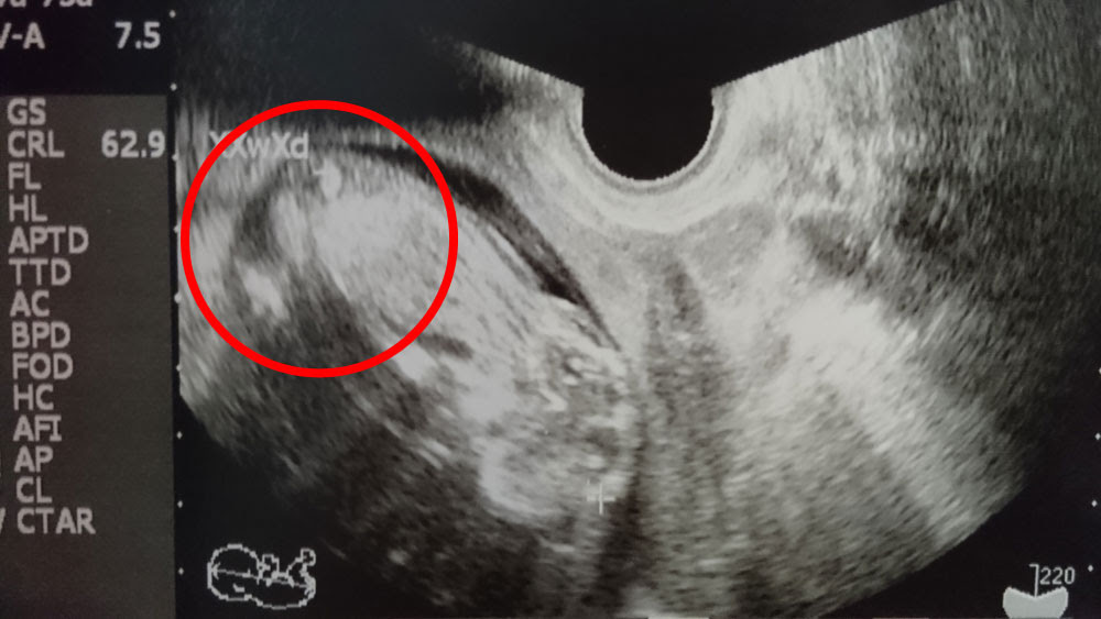 19週で性別判明 男の子と確定したエコー写真 ぽむらいふ おうちと暮らしを楽しむ