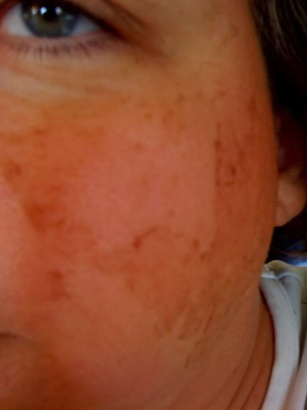 peel cheek