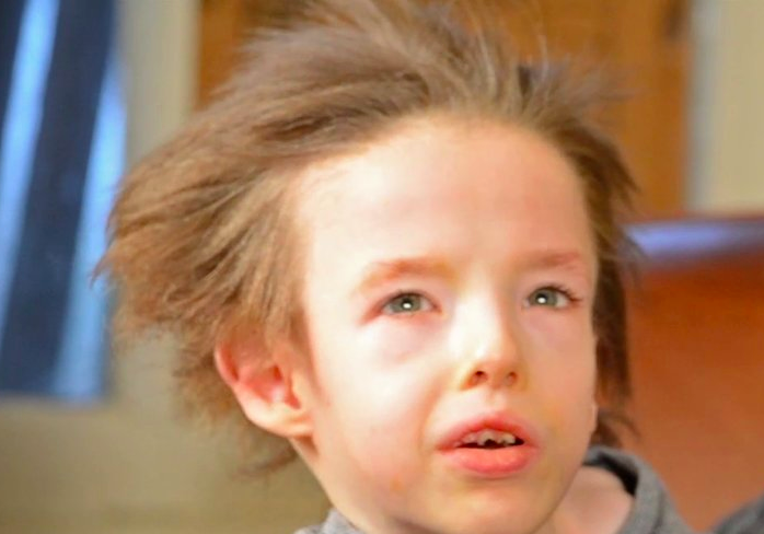 Menkes Disease Kinky Hair Syndrome Menkes Disease Kinky Hair Syndrome