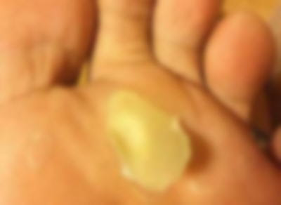 剣道での足のケガ 足の裏の皮がめくれた時のテーピング