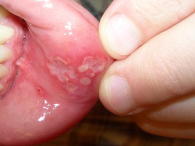 A mouth ulcer is a sore sore in 