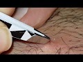 Clogged Hair Follicle Microscope