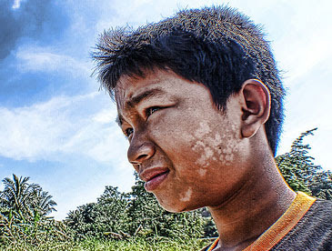 Petua Cara Menghilangkan Panau Yang Mujarab  Hairul.com